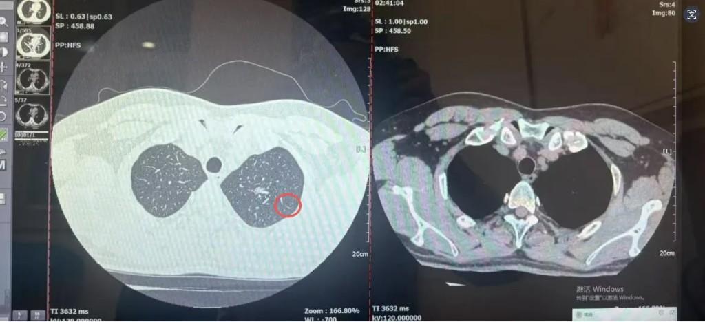 10mm肺结节暗藏早期肺癌 医院多学科72小时精准破局(图1) 10mm肺结节暗藏早期肺癌 医院多学科72小时精准破局(图1)